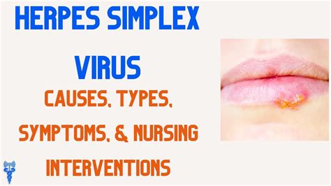 hermes simplex|what causes herpes simplex.